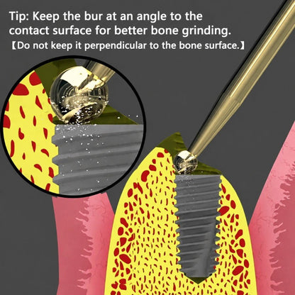 Implant Bone Contouring Round ball Bur - eedas.com